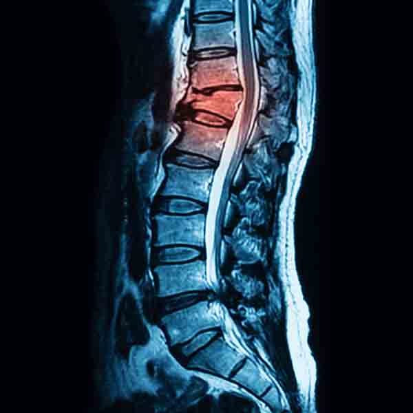 Minimally Invasive Spine Surgery NJ | Champey Pain & Spine