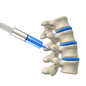 Facet Block Injection NJ | Champey Pain & Spine