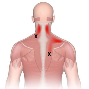 Trigger Point Injections for Back Pain NJ | Champey Pain & Spine